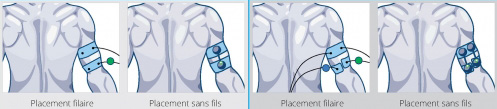placement electrodes-tendinopathie triceps brachial